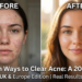 How Microbiome Science is Changing the Way We Clear Acne