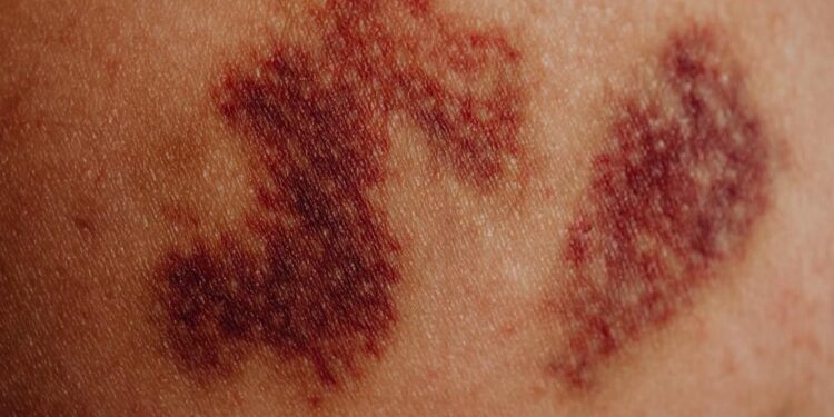 bruses related to liver disease