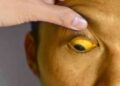 yellow eyes - jaundice - liver disease health magazine in uk