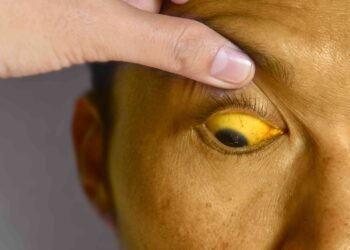 yellow eyes - jaundice - liver disease health magazine in uk