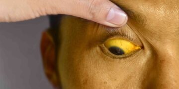 yellow eyes - jaundice - liver disease health magazine in uk