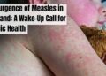 Resurgence of Measles in England: A Wake-Up Call for Public Health