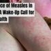 Resurgence of Measles in England: A Wake-Up Call for Public Health
